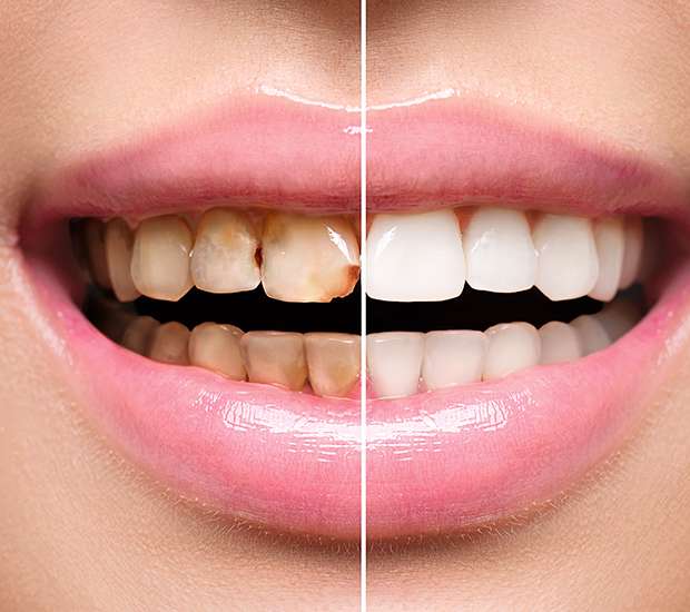Redwood City Dental Implant Restoration