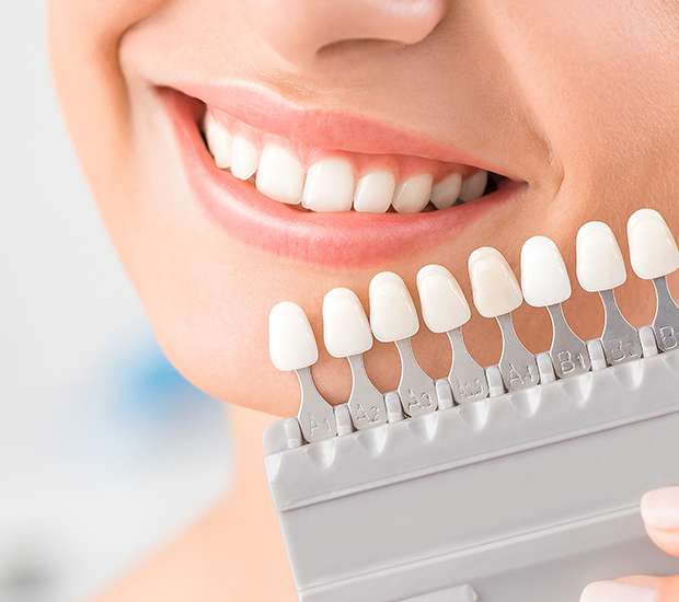 Redwood City Dental Veneers and Dental Laminates