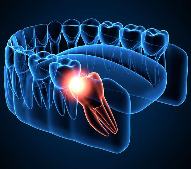 Redwood City Wisdom Teeth Extraction